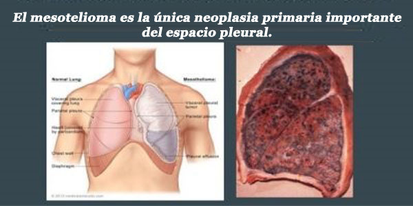 cancer de mesotelioma