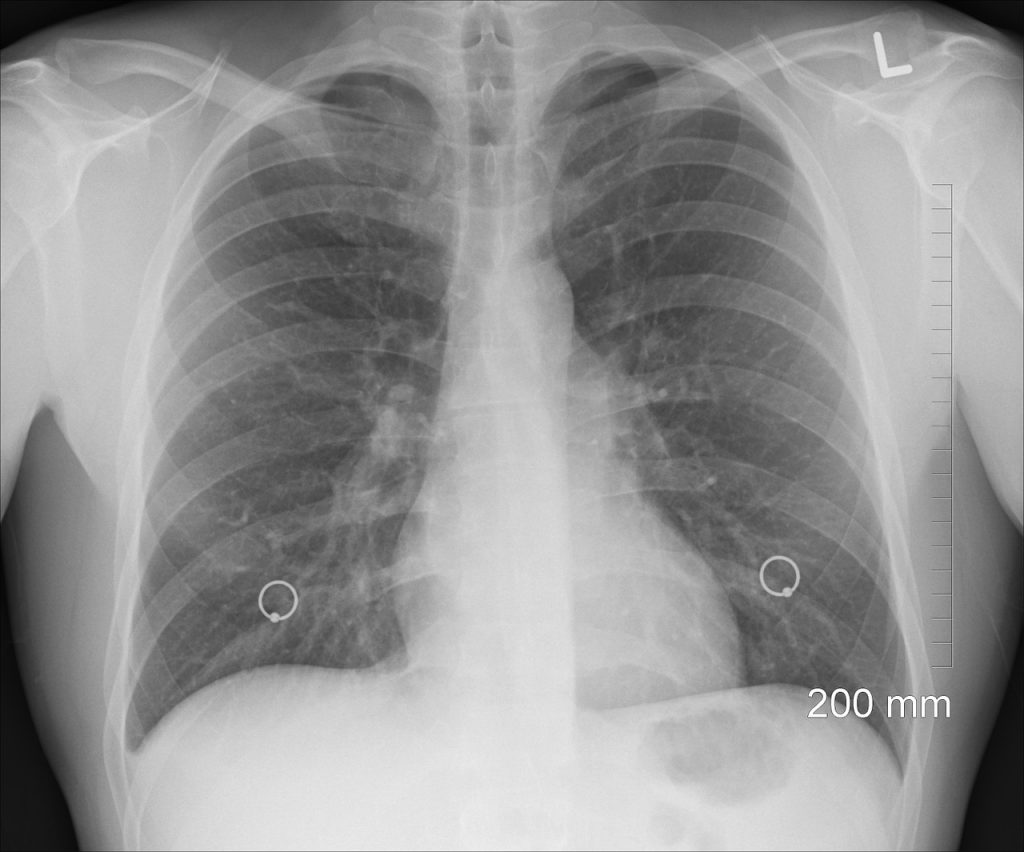CANCER DE MESOTELIOMA