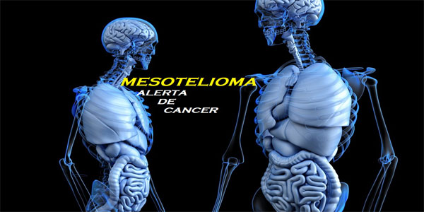 MESOTELIOMA QUE ES