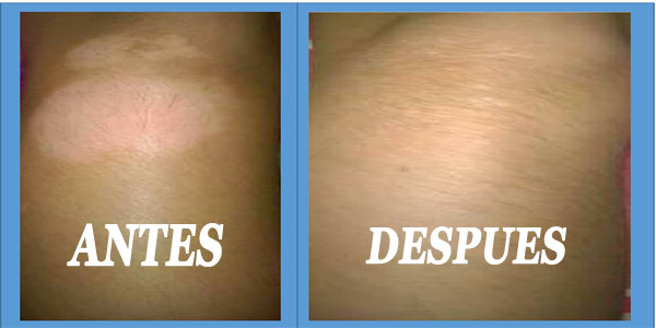 remedio para el vitiligo