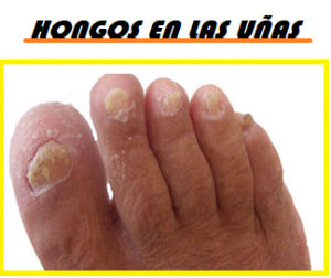 ELIMINAR LOS HONGOS EN LAS UÑAS