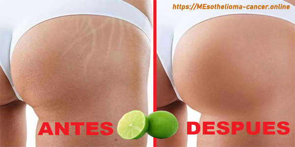 ELIMINAR LAS ESTRIAS