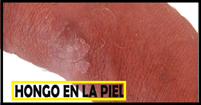 ELIMINAR LOS HONGOS