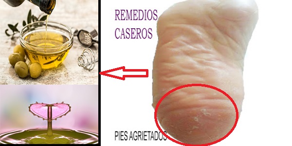 elimina los pies agrietados