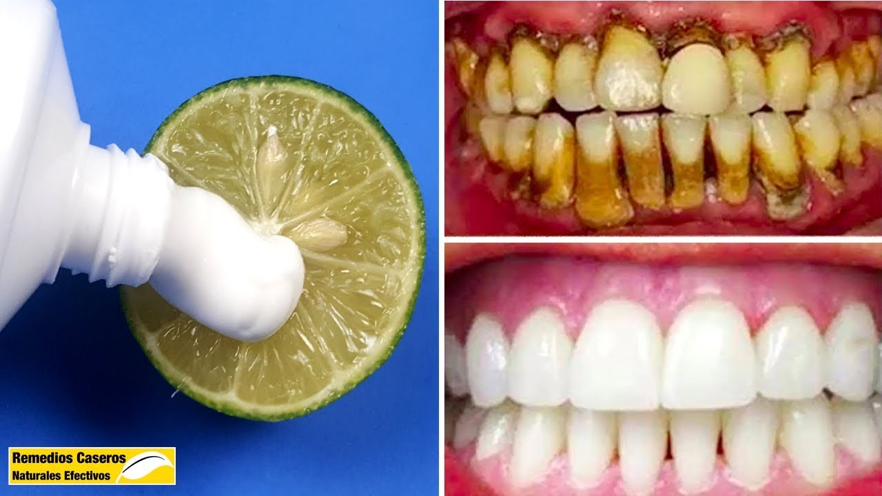 DIENTES BLANCOS EN 3 MINUTOS