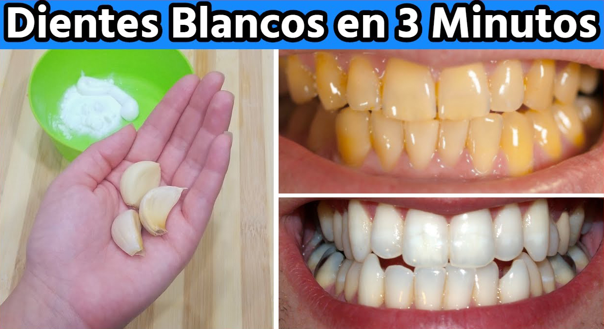 Blanqueamiento dental en casa en 2 minutos