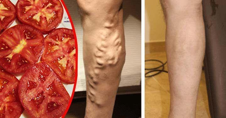 TOMATE UN ANTI INFLAMATORIO NATURAL PARA LAS VARICES, MIRA COMO HACERLO
